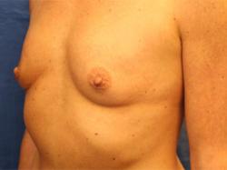 Before Results for Breast Augmentation