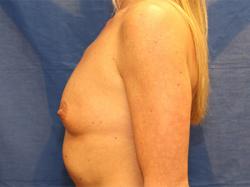 Before Results for Breast Augmentation