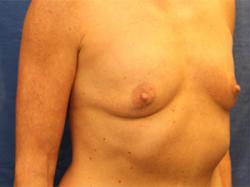 Before Results for Breast Augmentation