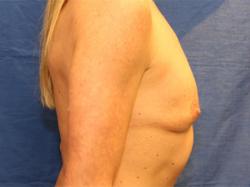 Before Results for Breast Augmentation