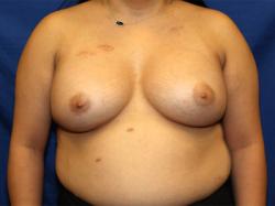 After Results for Breast Augmentation