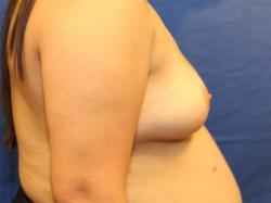 Before Results for Breast Augmentation