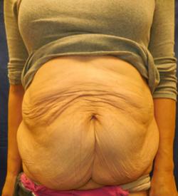 Before Results for Panniculectomy