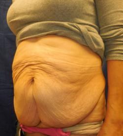 Before Results for Panniculectomy