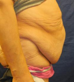 Before Results for Panniculectomy