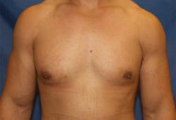 After Results for Gynecomastia