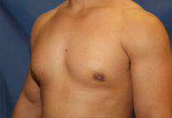 After Results for Gynecomastia