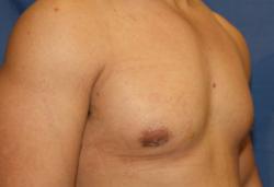 After Results for Gynecomastia