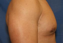 After Results for Gynecomastia