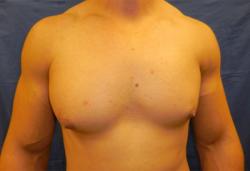 Before Results for Gynecomastia