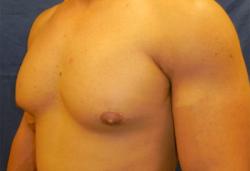 Before Results for Gynecomastia