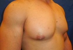 Before Results for Gynecomastia