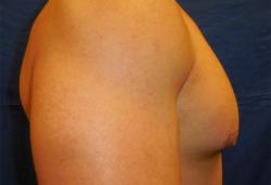 Before Results for Gynecomastia