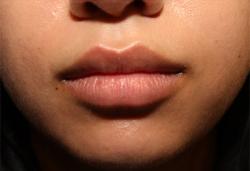 After Results for Lip Augmentation