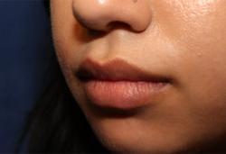 After Results for Lip Augmentation