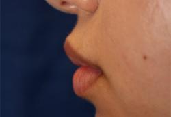 After Results for Lip Augmentation