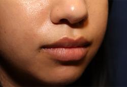 After Results for Lip Augmentation