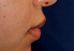 After Results for Lip Augmentation