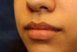 Before Results for Tissue Fillers, Lip Augmentation