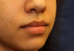 Before Results for Lip Augmentation