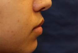 Before Results for Lip Augmentation