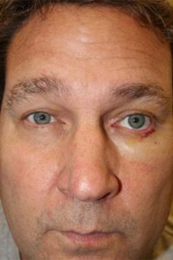 Before Results for Neuromodulators (Botox / Dysport)