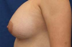 After Results for Breast Augmentation