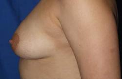 Before Results for Breast Augmentation