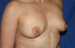 Before Results for Breast Augmentation