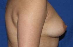 Before Results for Breast Augmentation