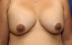 After Results for Breast Augmentation