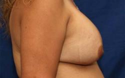 After Results for Breast Augmentation