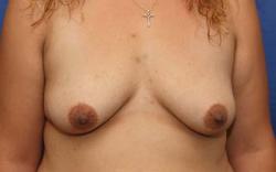 Before Results for Breast Augmentation