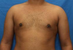 After Results for Gynecomastia