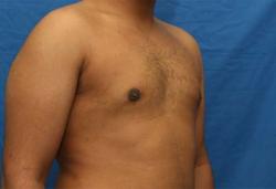 After Results for Gynecomastia