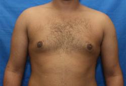 Before Results for Gynecomastia