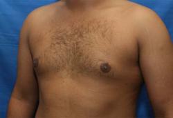 Before Results for Gynecomastia