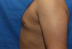 Before Results for Gynecomastia