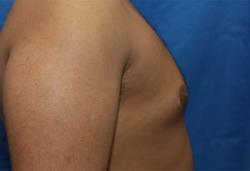 Before Results for Gynecomastia