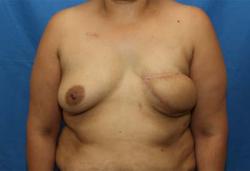 After Results for Breast Reconstruction