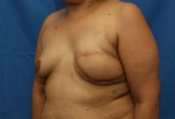 After Results for Breast Reconstruction
