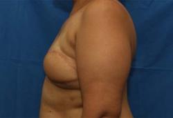 After Results for Breast Reconstruction