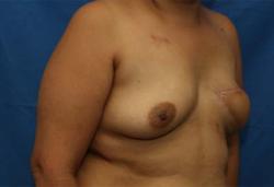 After Results for Breast Reconstruction