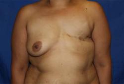 Before Results for Breast Reconstruction