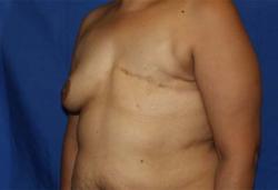 Before Results for Breast Reconstruction