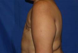 Before Results for Breast Reconstruction