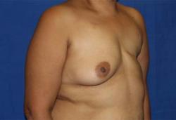 Before Results for Breast Reconstruction