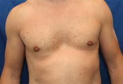 After Results for Gynecomastia