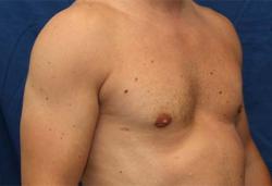 After Results for Gynecomastia