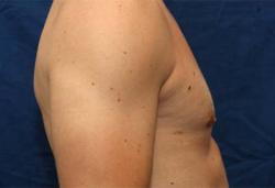 After Results for Gynecomastia